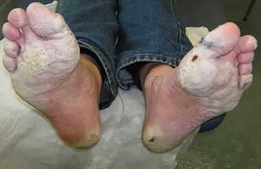 trench-foot-symptom.jpg