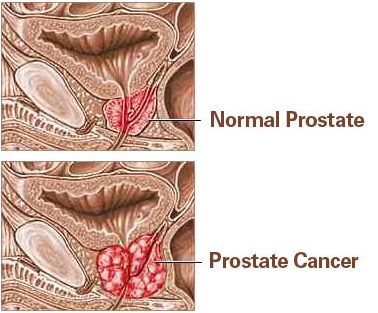 prostatecancer1.jpg